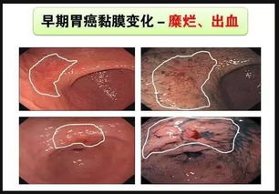 慢性萎縮性胃炎中醫(yī)治療方法有哪些