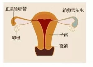 預(yù)防輸卵管積水的方法有哪些