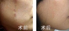 疤痕修復(fù)用什么方法有哪些方法