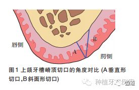 組織切開的方法有哪些