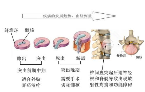 吊線風的治療方法有哪些