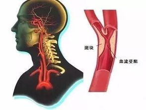 動脈硬化的治療方法有哪些動脈硬化怎么辦