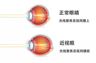 近視眼的矯正的方法有哪些