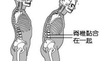 最新強(qiáng)直性脊柱炎治療方法有哪些