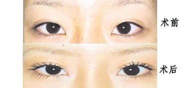 開眼角手術(shù)后怎樣護理方法有哪些