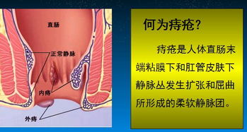 江門痔瘡治療的方法有哪些