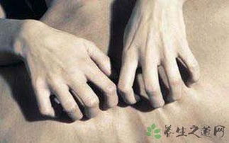 人工性蕁麻疹注意事項,熱性蕁麻疹注意事項,季節(jié)性蕁麻疹注意事項
