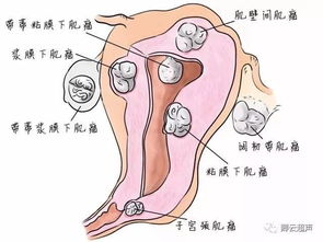 子宮肌瘤患者月經(jīng)期注意事項(xiàng)