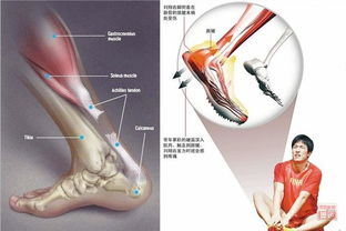 跟腱術(shù)后注意事項(xiàng),跟腱受傷注意事項(xiàng),穿跟腱靴注意事項(xiàng)