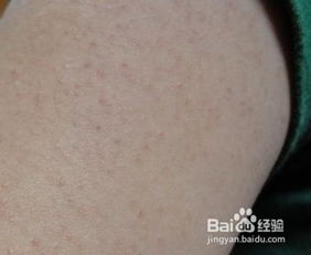 腿上雞皮疙瘩注意事項