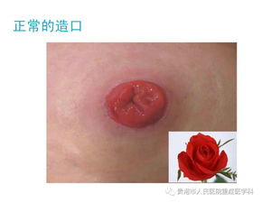 十二指腸穿孔術(shù)后注意事項,腸穿孔術(shù)后的注意事項,腸穿孔造瘺術(shù)后注意事項多久恢復(fù)