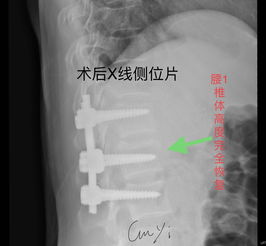 腰椎骨折手術(shù)術(shù)中注意事項(xiàng)