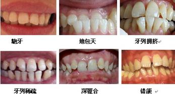 裝隱形牙后24小時注意事項