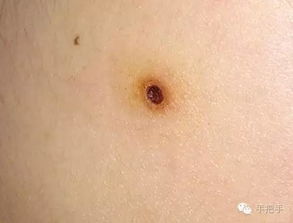 電離子點(diǎn)痣后注意事項(xiàng),點(diǎn)痣注意事項(xiàng)點(diǎn)痣忌口,點(diǎn)痣后注意事項(xiàng)