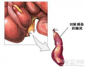 孕婦慢性闌尾炎注意事項(xiàng)
