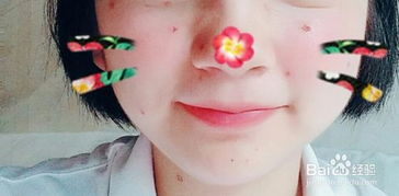 電燒法點(diǎn)痣的注意事項(xiàng)