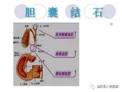 剛做完膽囊切除應(yīng)注意事項(xiàng)