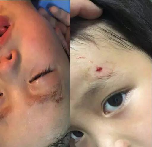 寶寶額頭縫針后注意事項(xiàng)