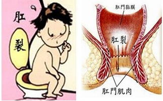 手術(shù)后,注意事項(xiàng),小孩,肛裂