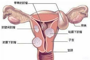 做了子宮肌瘤手術后注意事項