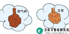 肺氣腫患者應(yīng)注意事項,肺氣腫多喝水應(yīng)注意事項,肺氣腫怕累嗎?應(yīng)注意事項