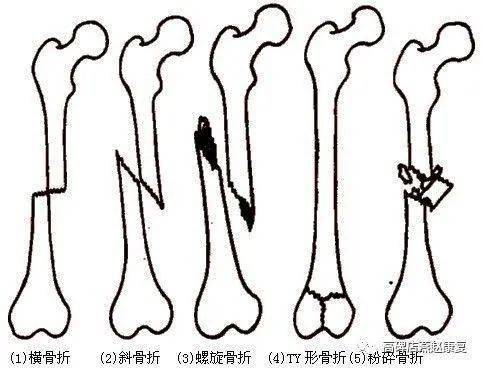 尾骨骨折后注意事項(xiàng)