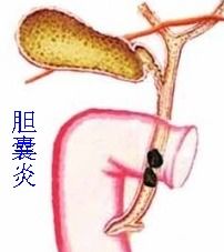 女人膽結(jié)石注意事項(xiàng)