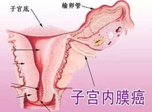 子宮內(nèi)膜癌化療注意事項(xiàng)
