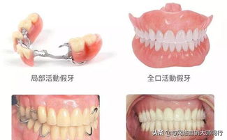 活動(dòng)義齒的注意事項(xiàng),活動(dòng)義齒佩戴注意事項(xiàng),活動(dòng)義齒的適應(yīng)癥和禁忌癥