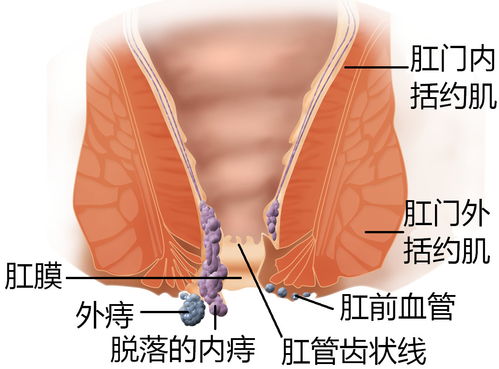 痔瘡肛瘺術前術后注意事項