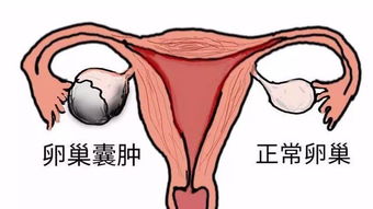 左側(cè)卵巢囊腫注意事項(xiàng)