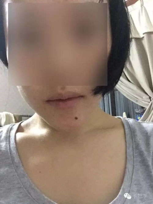 注意事項(xiàng),電燒法點(diǎn)痣