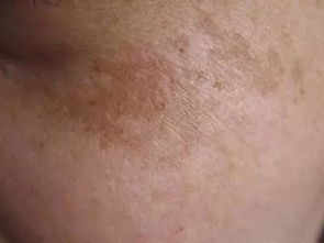 長痘痘洗臉怎么注意事項(xiàng)