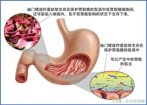 吃治療幽門桿菌的藥注意事項