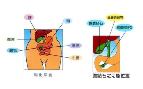 膽結(jié)石注意事項(xiàng)及飲食,膽結(jié)石患者注意事項(xiàng),膽結(jié)石微創(chuàng)手術(shù)注意事項(xiàng)