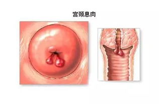 leep刀宮頸息肉手術后注意事項
