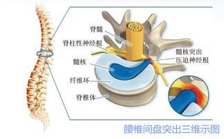 腰椎間盤突出癥患者注意事項有哪些呢?,腰椎間盤突出癥的注意事項,腰椎間盤突出癥出院注意事項