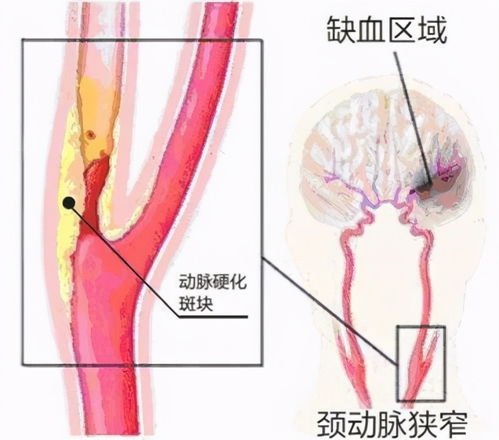 檢查頸動脈注意事項