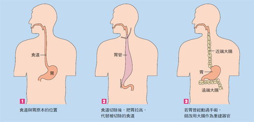 食道隆起esd手術后注意事項
