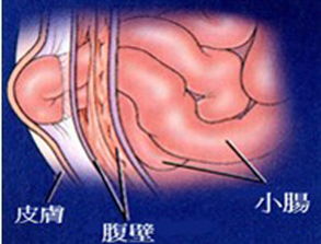 有什么,疝氣,手術(shù)后,注意事項