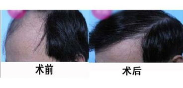 頭發(fā),種植,注意事項(xiàng)