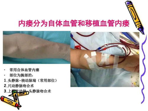 動靜脈瘺護理注意事項
