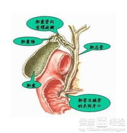 膽結(jié)石,注意事項,發(fā)生