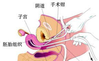 刮宮之后的注意事項(xiàng),無(wú)痛刮宮前注意事項(xiàng),刮宮手術(shù)后注意事項(xiàng)