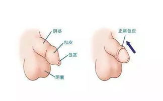 包皮長(zhǎng)自己天天注意事項(xiàng)才能不長(zhǎng)
