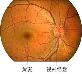 黃斑水腫飲食注意事項,黃斑出血飲食注意事項,眼病白內(nèi)障術(shù)后飲食有什么注意事項