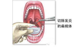 扁桃體摘除手術(shù)后注意事項(xiàng)