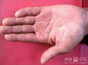 皮下結(jié)節(jié)注意事項(xiàng)