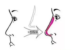 取鼻假體注意事項(xiàng),取假體術(shù)后注意事項(xiàng),取下巴假體注意事項(xiàng)