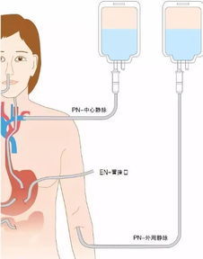 腸外營(yíng)養(yǎng)支持的注意事項(xiàng)
